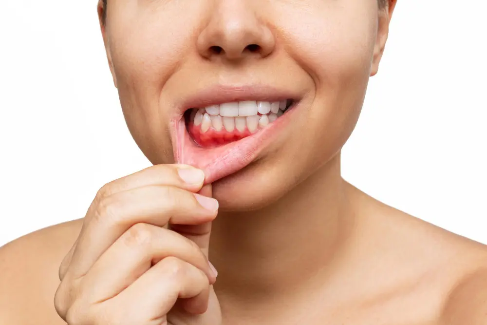Gum Disease