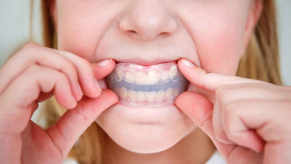 Child wearing a custom clear sports mouthguard to protect teeth during sports and recreational activities.