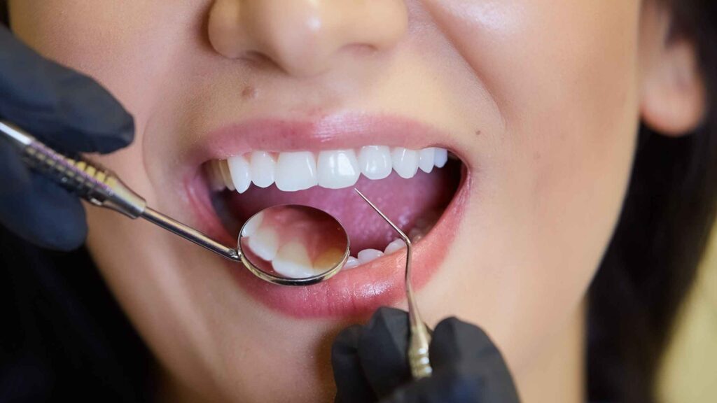 Dentist examining a patient’s teeth for signs of enamel erosion and tooth wear
