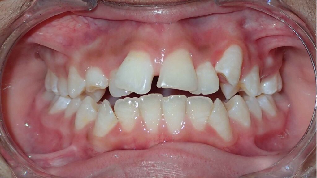 Crowded and misaligned teeth showing visible dental concerns